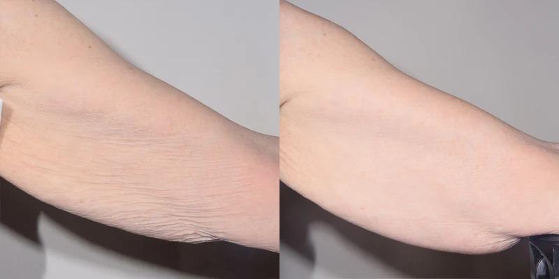 Before and after using Alastin TransFORM Body Treatment, improved skin firmness and reduced laxity