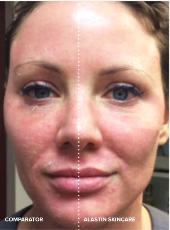 Before and after using Alastin Ultra Light Moisturizer, improved skin hydration and reduced redness