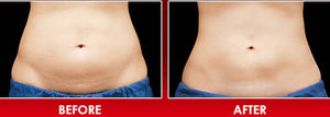 Alastin TransFORM Body Treatment before and after abdomen results showing firmer smoother skin with improved tone and texture