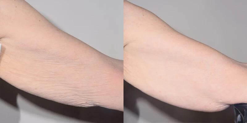 Alastin TransFORM Body Treatment before and after arm results showing firmer smoother skin with improved texture