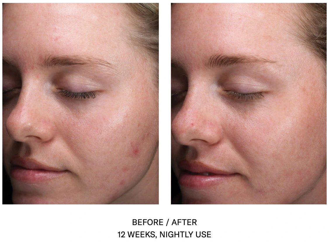 Before and after 12 weeks of SkinBetter AlphaRet Clearing Serum showing clearer skin and reduced acne visibility