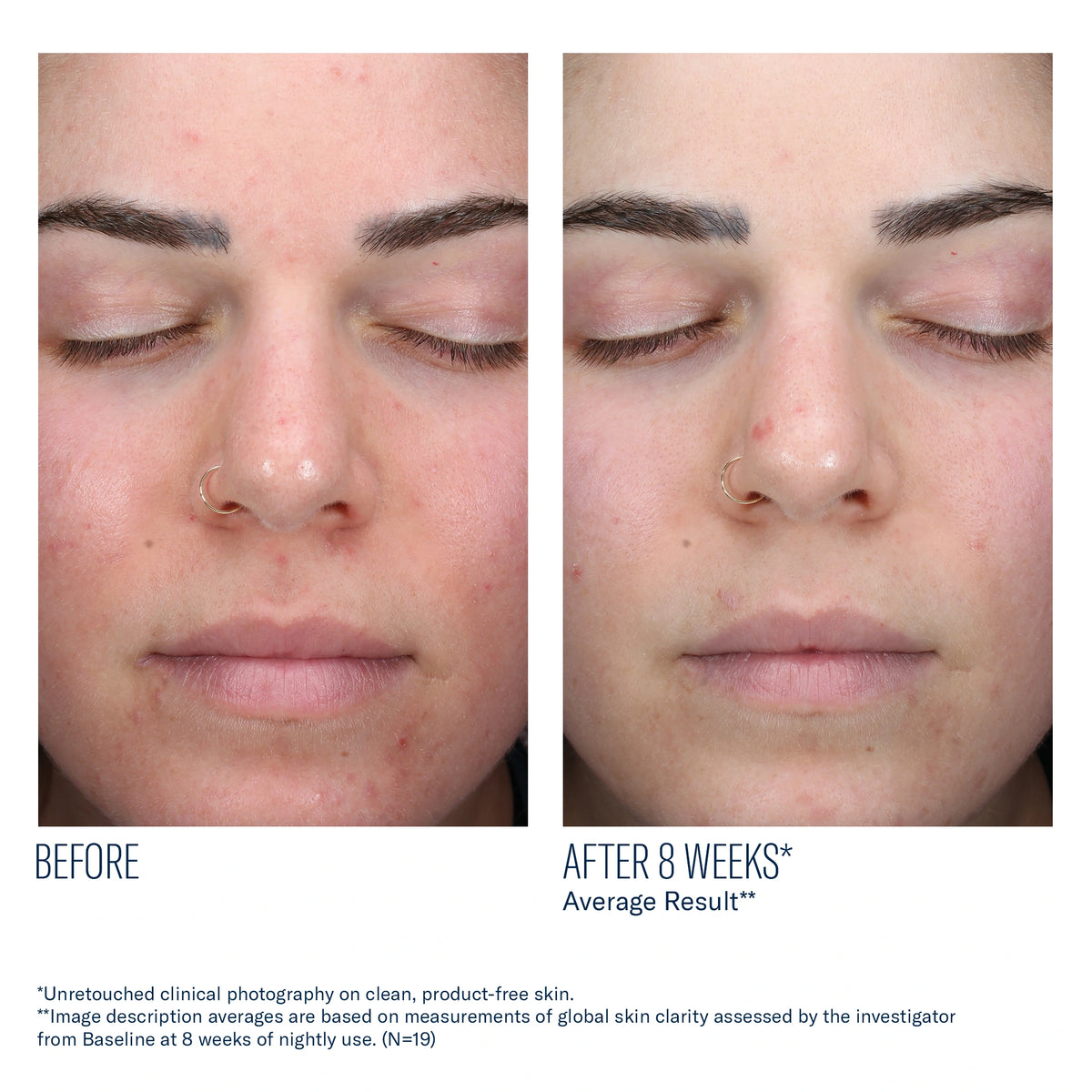Before and after 8 weeks of SkinBetter AlphaRet Clearing Serum showing improved skin clarity and reduced acne appearance