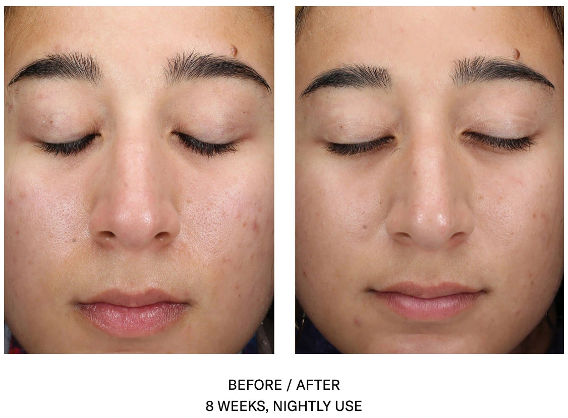 Before and after 8 weeks of SkinBetter AlphaRet Clearing Serum showing clearer skin and reduced acne appearance