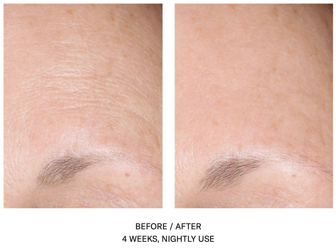 AlphaRet Overnight Cream before and after showing reduced forehead wrinkles after 4 weeks of nightly alpharet use