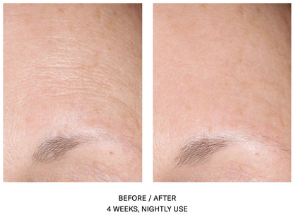 AlphaRet Overnight Cream before and after showing reduced forehead wrinkles after 4 weeks of nightly alpharet use