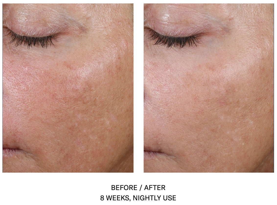 AlphaRet Overnight Cream before and after showing improved skin texture and even tone after 8 weeks of nightly use