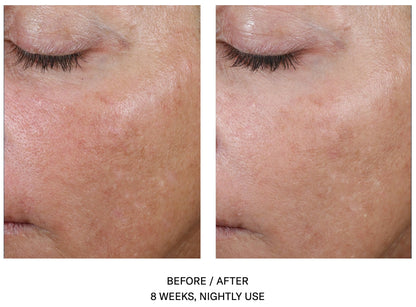AlphaRet Overnight Cream before and after showing improved skin texture and even tone after 8 weeks of nightly use