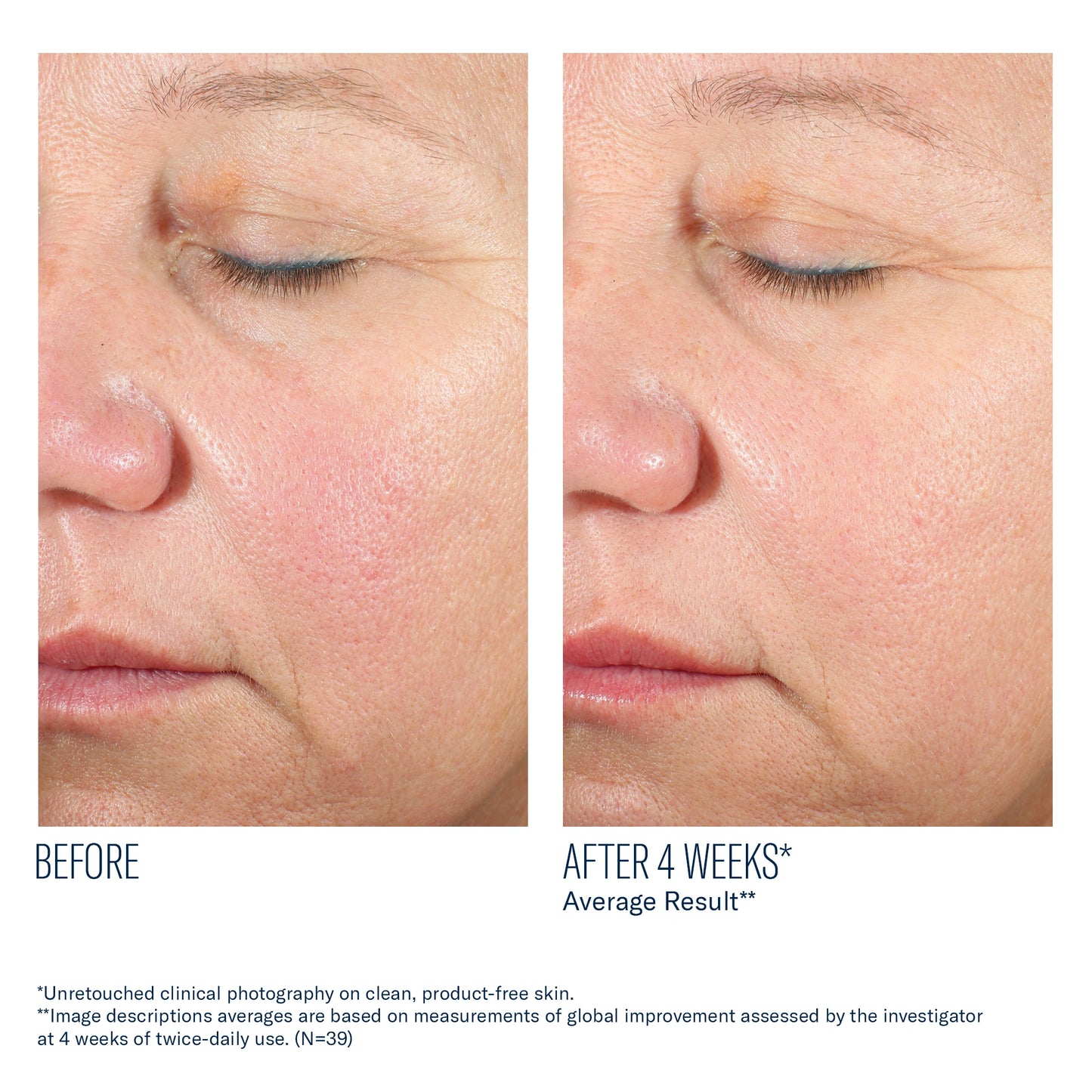 Before and after 4 weeks using Alto Advanced Defense and Repair Serum showing smoother skin texture and reduced redness