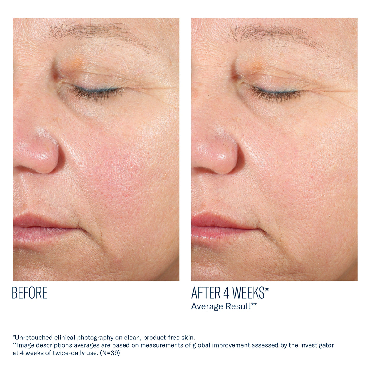 Before and after 4 weeks using Alto Advanced Defense and Repair Serum showing smoother skin texture and reduced redness