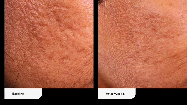 Before and after of Biojuve Hydrating Barrier Cream showing improved skin texture and reduced discoloration after 8 weeks