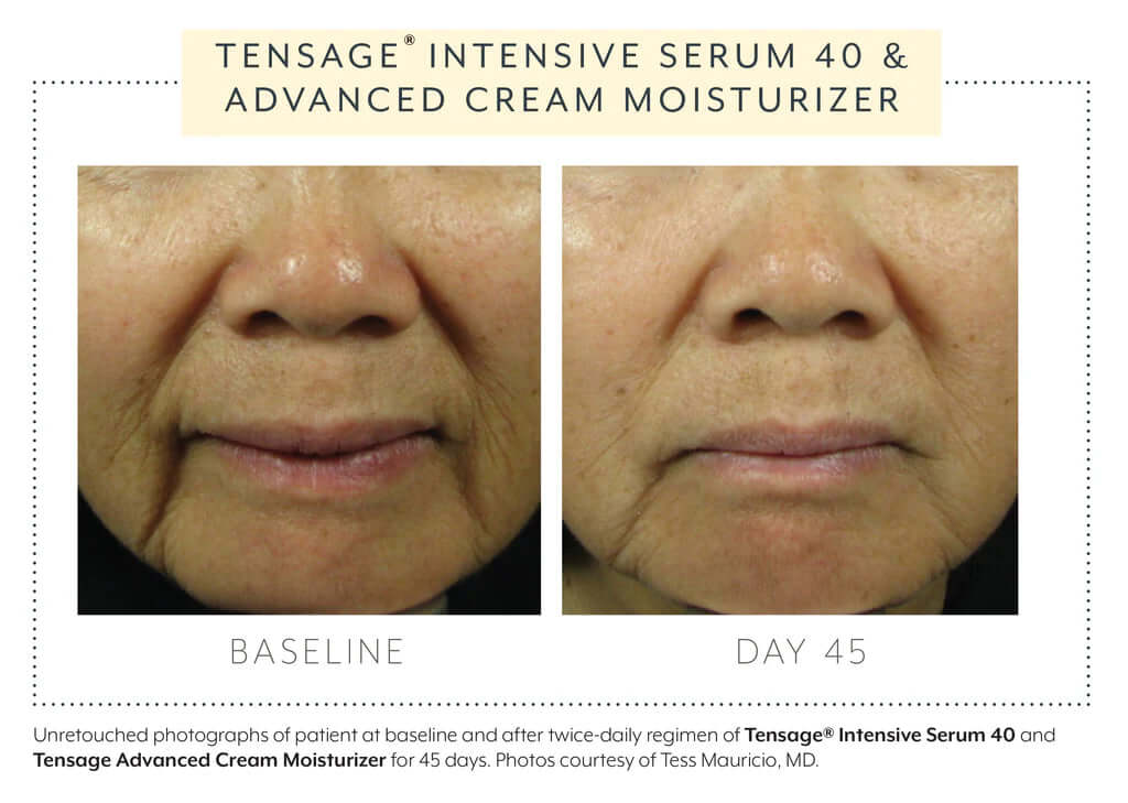 Biopelle Tensage Intensive Serum 40 before and after 45 days — visible improvement in skin tone, texture, and fine lines