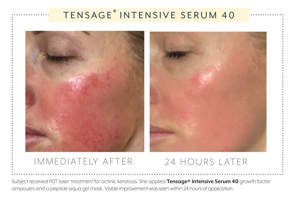 Biopelle Tensage Serum 40 post-PDT treatment results — skin improvement visible immediately and 24 hours after procedure