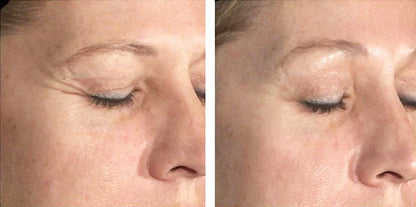 Before and after using Biopelle Tensage Intensive Serum 40, noticeable reduction in eye wrinkles and smoother skin texture