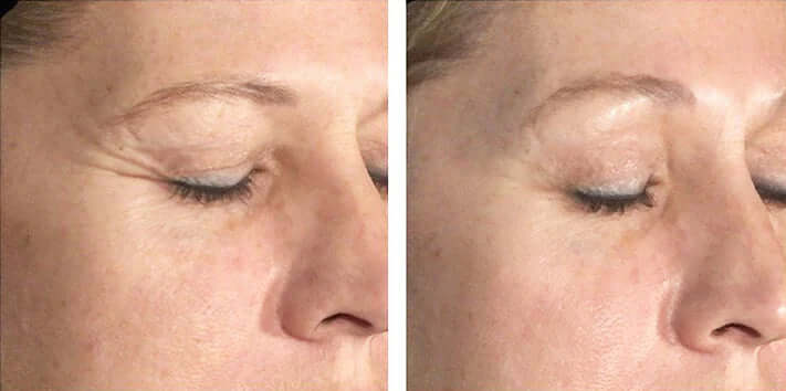 Biopelle Tensage Intensive Serum 40 skin results — brighter, firmer, more even complexion after using SCA BioRepair ampoules