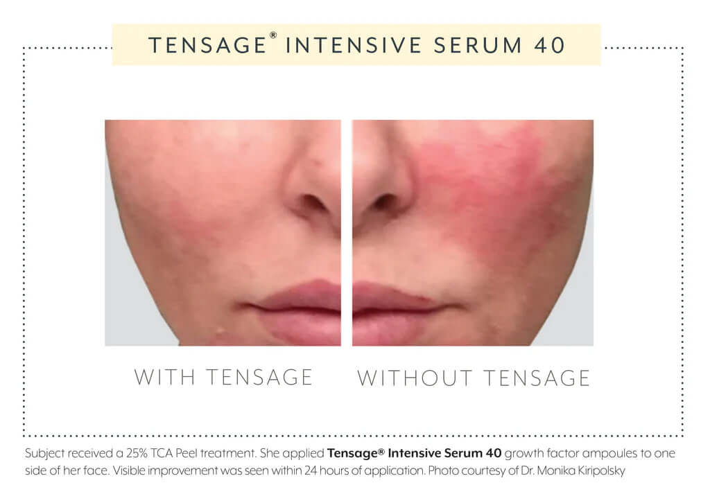 Biopelle Tensage Intensive Serum 40 split-face comparison — 24-hour result showing reduced redness and improved skin radiance