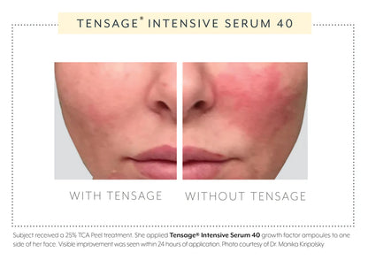 24-hour post-TCA peel results with and without Biopelle Tensage Serum 40, showing faster recovery on treated side