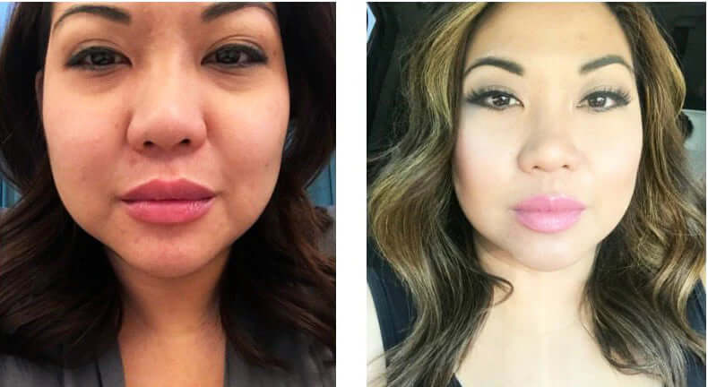 Biopelle Tensage Stem Cell Cream before and after comparison shows facial skin tone, texture and smoother looking face skin.