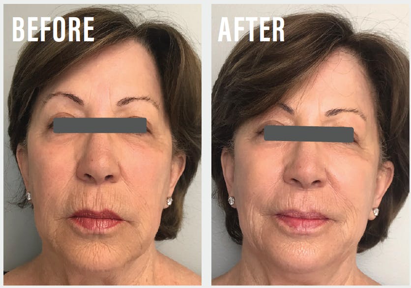 Before and after using Biopelle Tensage Stem Cell Cream, noticeable reduction in facial wrinkles and improved skin tone