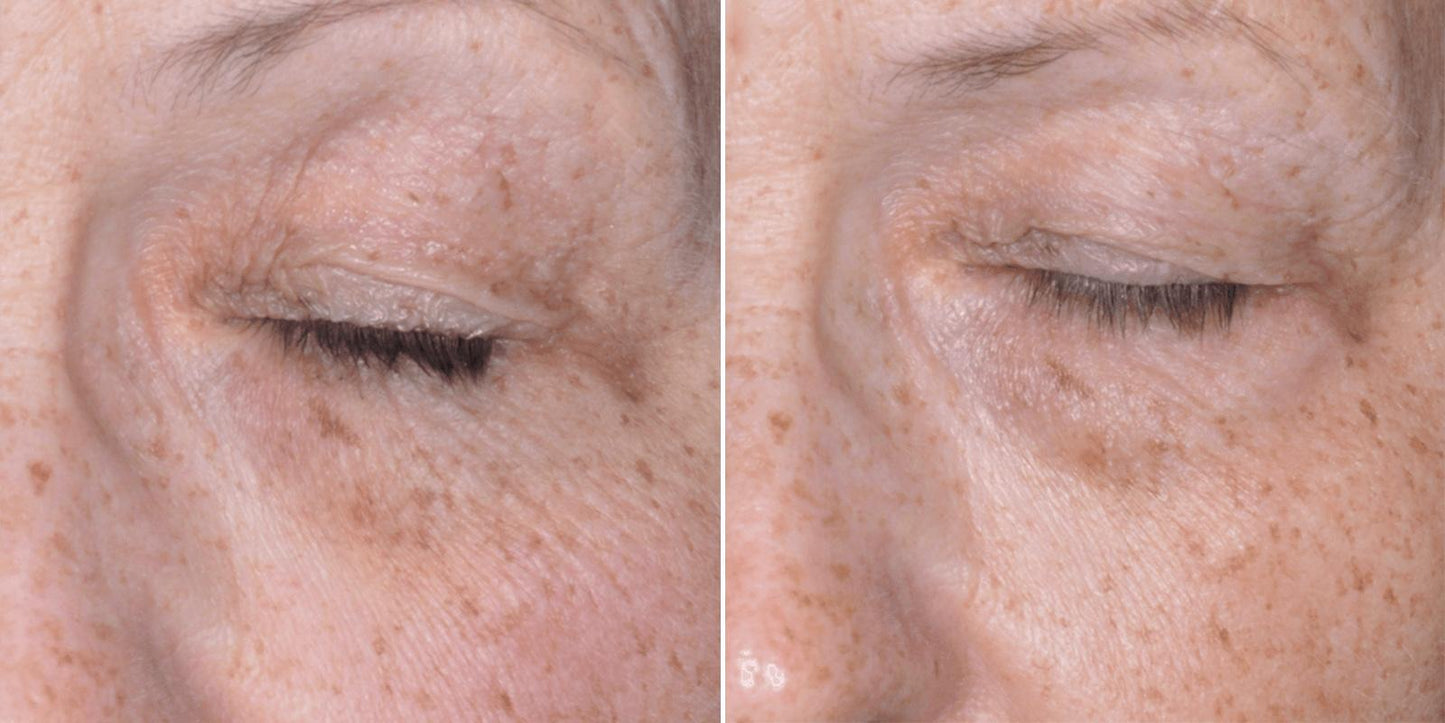 Before and after 8 weeks using Biopelle Tensage Eye Cream, noticeable reduction in wrinkles and smoother skin