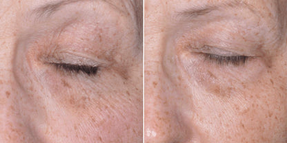 Biopelle Tensage Stem Cell Eye Cream before and after view shows eye area fine lines and wrinkles by eyelids, smoother skin.