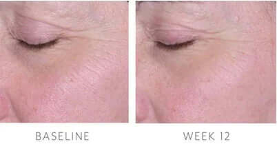 Biopelle Tensage Stem Cell Eye Cream baseline to week 12 comparison shows softer eye area fine lines near eyelid skin shown