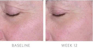 Biopelle Tensage Stem Cell Eye Cream baseline to week 12 comparison shows softer eye area fine lines near eyelid skin shown