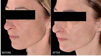 Cyspera Intensive 7 before and after side view shows brown patches, dark spots and a smoother, even-looking facial skin tone