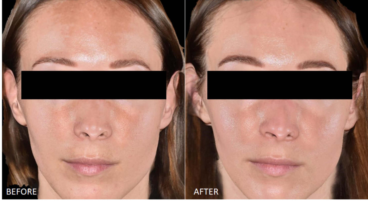 Cyspera Intensive 7 before and after face photo shows uneven skin tone, dark spots and smoother, clearer-looking facial skin