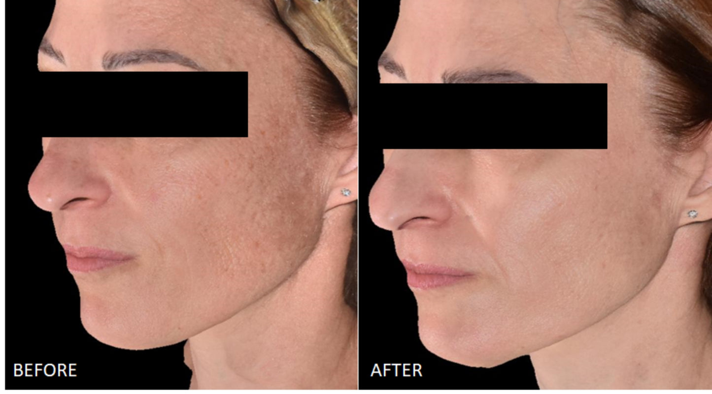 Before and after using Cyspera Intensive 7% Serum, visible reduction in facial hyperpigmentation