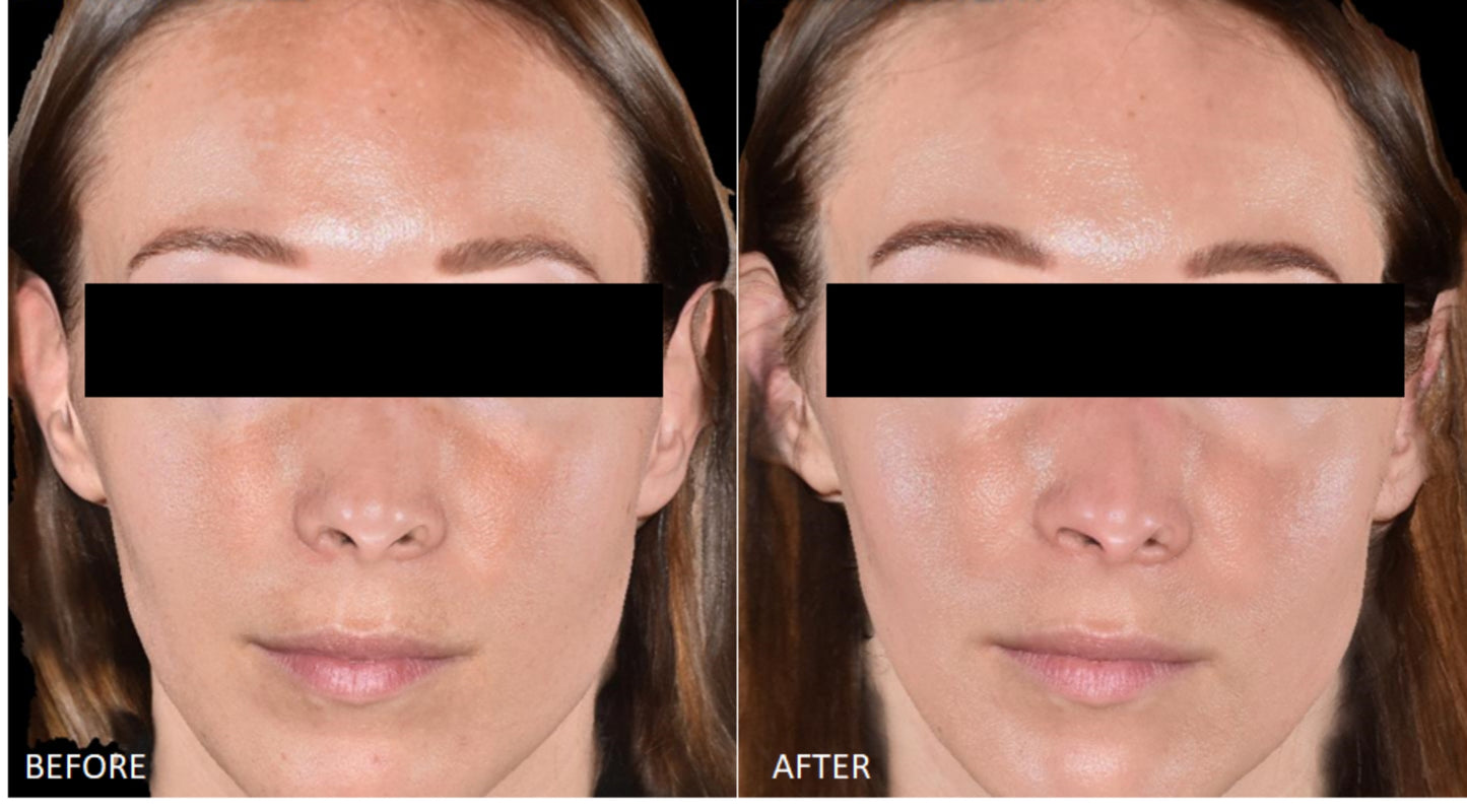 Before and after results with Cyspera Intensive 7% Serum, significant improvement in skin tone and clarity