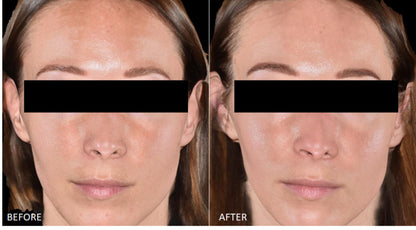 Before and after results with Cyspera Intensive 7% Serum, significant improvement in skin tone and clarity