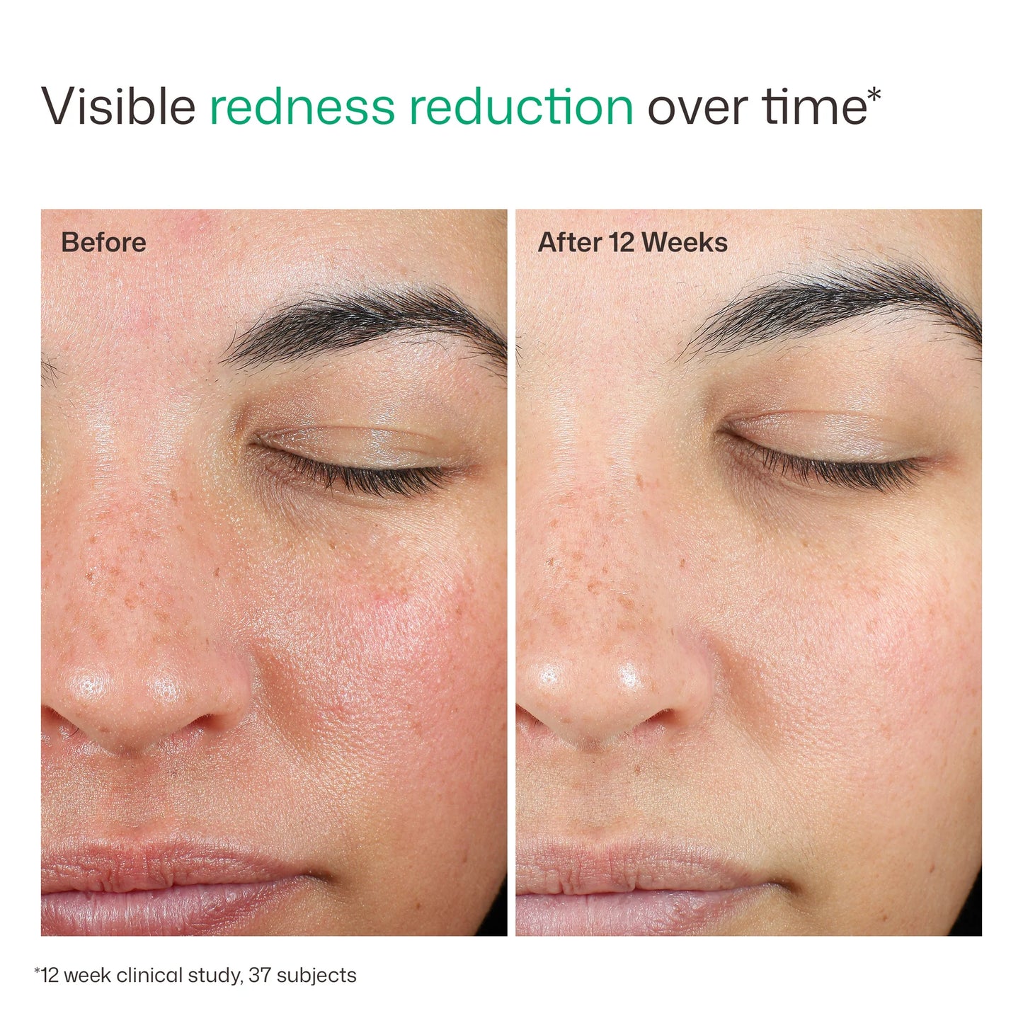 EltaMD UV Skin Recovery SPF 50 before and after clinical image showing visible redness reduction after 12 weeks results
