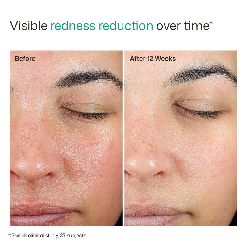 EltaMD UV Skin Recovery SPF 50 before and after clinical image showing visible redness reduction after 12 weeks results