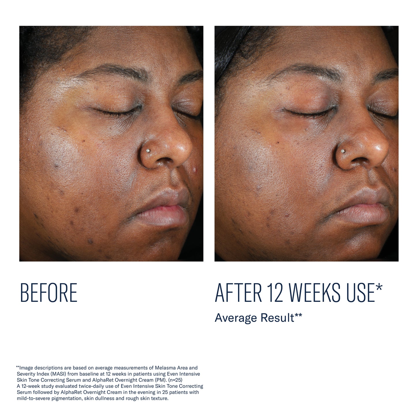Before and after using SkinBetter Even Intensive Skin Tone Correcting Serum showing reduced dark spots after 12 weeks