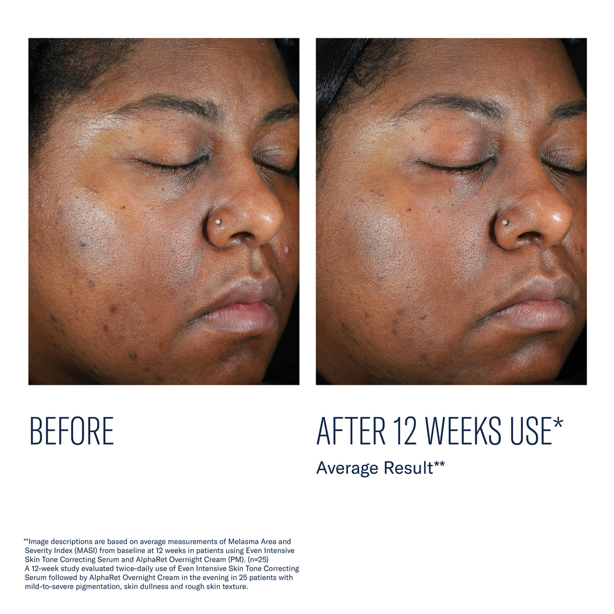 Before and after using SkinBetter Even Intensive Skin Tone Correcting Serum showing reduced dark spots after 12 weeks
