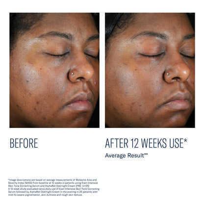 Before and after using SkinBetter Even Intensive Skin Tone Correcting Serum showing reduced dark spots after 12 weeks