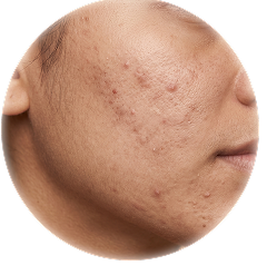 Acne + Acne Scarring