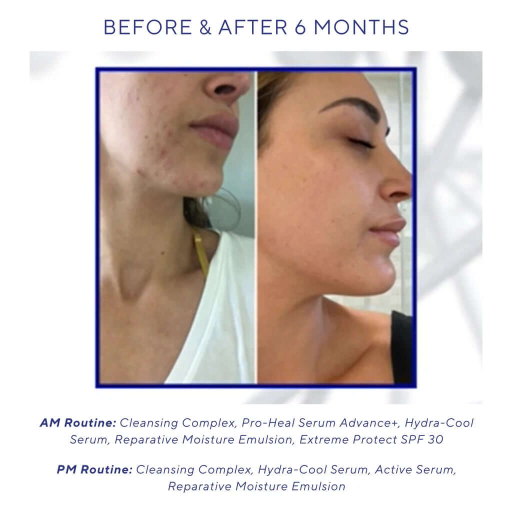iS Clinical Hydra-Cool Serum before and after 6 months image showing calmer-looking acne-prone skin routine results use now.
