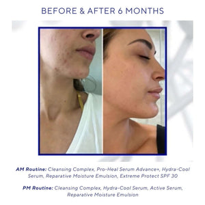 iS Clinical Hydra-Cool Serum before and after 6 months image showing calmer-looking acne-prone skin routine results use now.