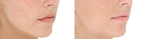 Side-by-side acne improvement photo showing clearer cheek skin after LightStim for Acne blue and red LED therapy results now