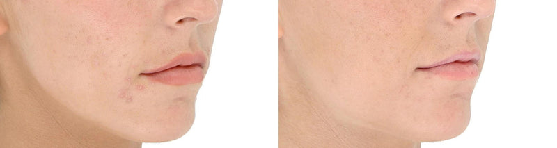 Side-by-side acne improvement photo showing clearer cheek skin after LightStim for Acne blue and red LED therapy results now