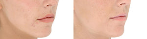 LightStim- for Acne (Non-Refundable)-The Skin Spot