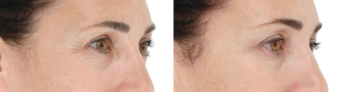 LightStim for Wrinkles before and after eye area comparison showing smoother fine lines from LED use at home treatment today