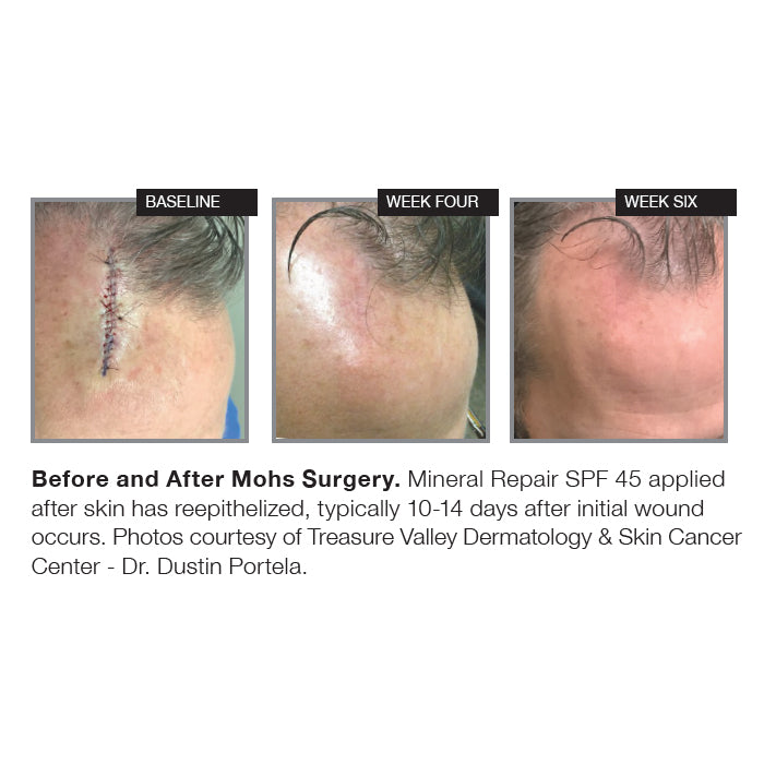 Before and after progression of Mohs surgery wound healing over six weeks, with Mineral Repair SPF 45