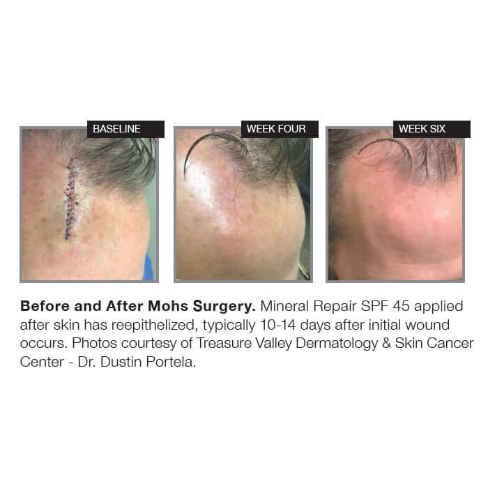 NazarianSkin SPF 45 sunscreen Mohs surgery healing results showing baseline week four and week six improvement in skin repair