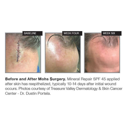 NazarianSkin SPF 45 sunscreen Mohs surgery healing results showing baseline week four and week six improvement in skin repair