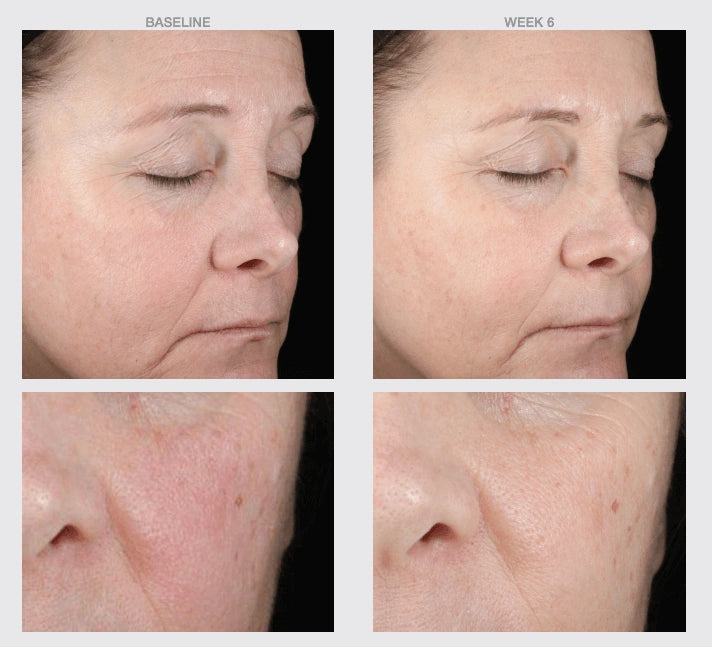 NazarianSkin HA Boost serum before and after results showing smoother skin texture improved hydration and reduced fine lines.