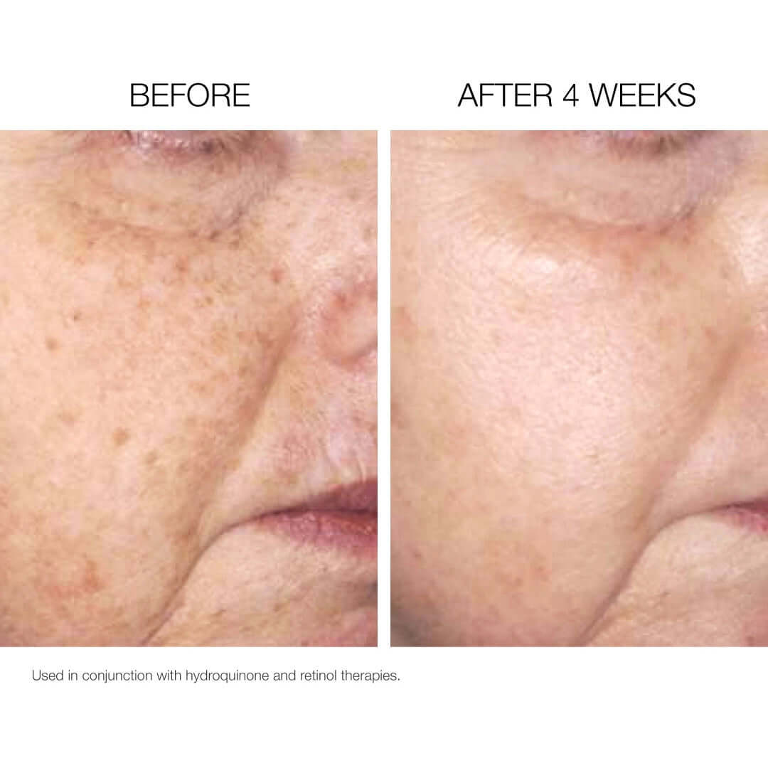 NazarianSkin Illuminate Brightening Pads before after 4 weeks showing reduced dark spots improved tone and brighter skin