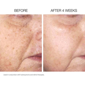 NazarianSkin Illuminate Brightening Pads before after 4 weeks showing reduced dark spots improved tone and brighter skin