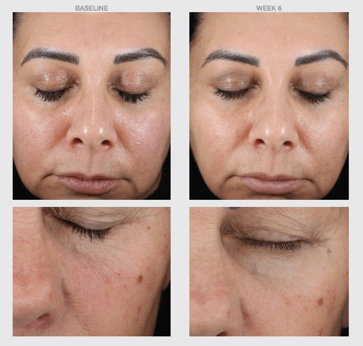 NazarianSkin retinol serum before and after results showing smoother skin reduced wrinkles improved tone and clearer skin